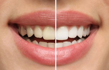 Blanchiment des dents