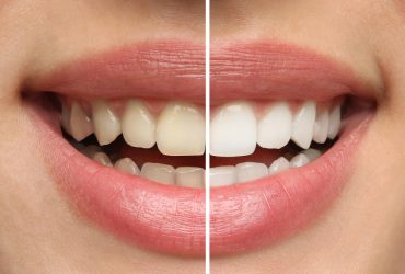 Blanchiment des dents