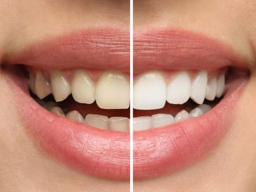 Blanchiment des dents